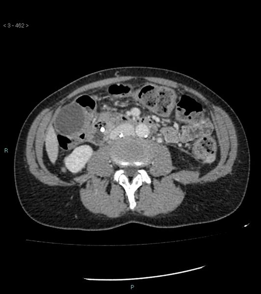 File:Ampulla of Vater metastasis (Radiopaedia 27820-28069 A 100).jpg