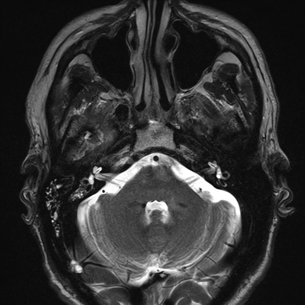 File:Anaplastic meningioma with recurrence (Radiopaedia 34452-35788 Axial T2 1).png