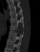 CT scan: ABC spine