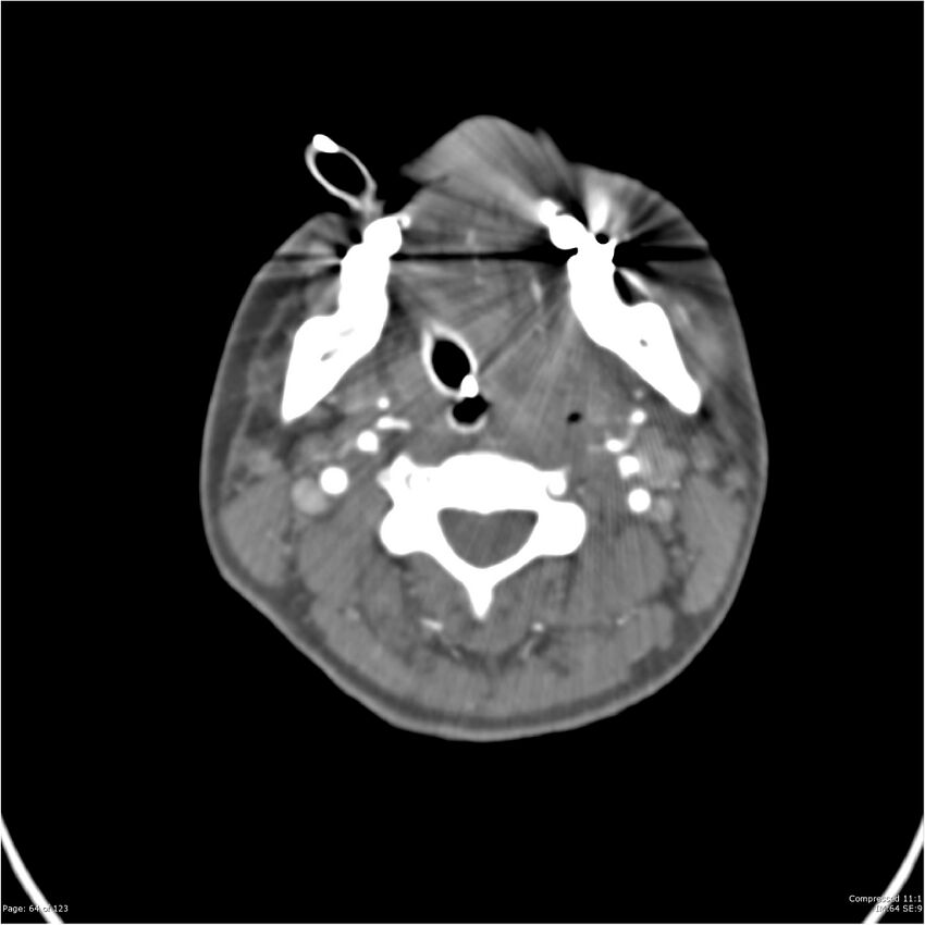 Aneurysmal subarachnoid hemorrhage and Moya Moya disease (Radiopaedia 34306-35593 Axial CT COW 64).jpg