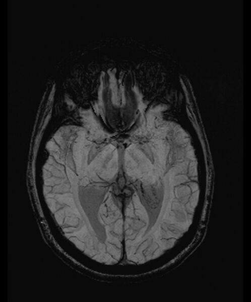 File:Angiomatous meningioma (Radiopaedia 79459-92579 E 31).jpg
