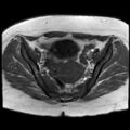 Ano-vaginal fistula (Radiopaedia 29765-30284 Axial T1 22).jpg