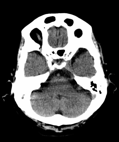 File:Anomalous intracranial venous drainage (Radiopaedia 28161-28418 Axial 45).png