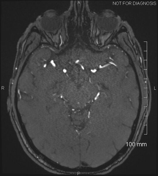 File:Anterior cerebral artery aneurysm (Radiopaedia 80683-94127 Axial MRA 101).jpg