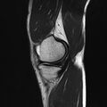 Anterior cruciate ligament full thickness tear (Radiopaedia 66268-75467 Sagittal T2 6).jpg