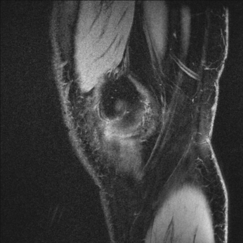 Anterior cruciate ligament mucoid degeneration (Radiopaedia 68400-77933 Sagittal 61).jpg