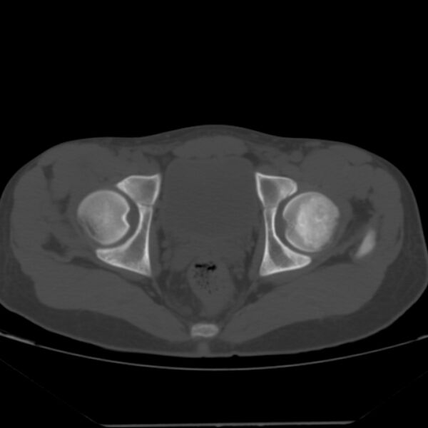 File:Anterior inferior iliac spine avulsion fracture (Radiopaedia 49469-54627 Axial bone window 40).jpg