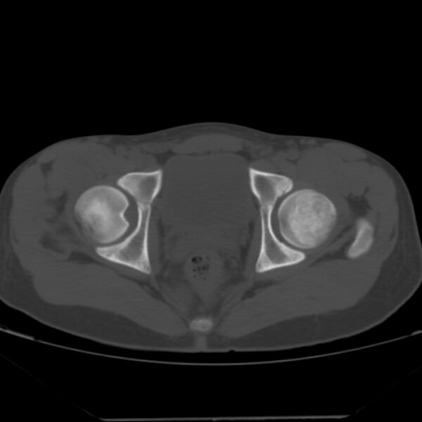File:Anterior inferior iliac spine avulsion fracture (Radiopaedia 49469-54627 Axial bone window 41).jpg