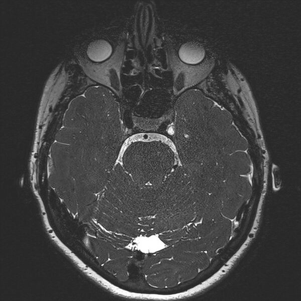 File:Anterior temporal encephalocele (Radiopaedia 82624-96808 Axial T2 high res 58).jpg