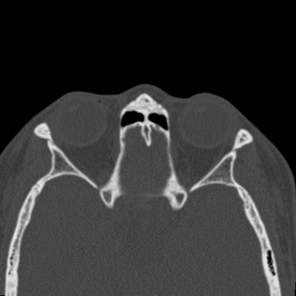 File:Antrochoanal polyp (Radiopaedia 21894-21868 Axial bone window 35).jpg