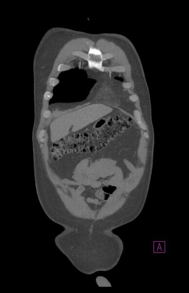 File:Aortectomy and axillary-bifemoral bypass (Radiopaedia 28303-28545 C 17).jpg