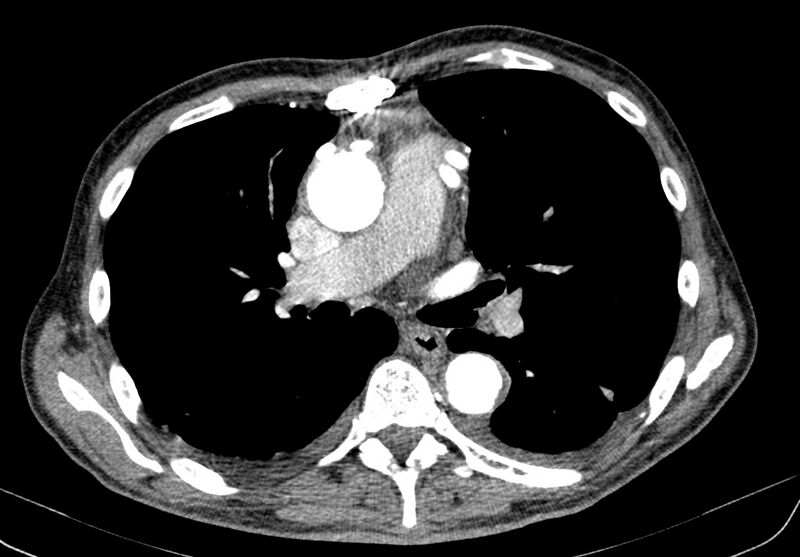 File:Aortic arch saccular aneurysm (Radiopaedia 19430-19457 B 19).jpg