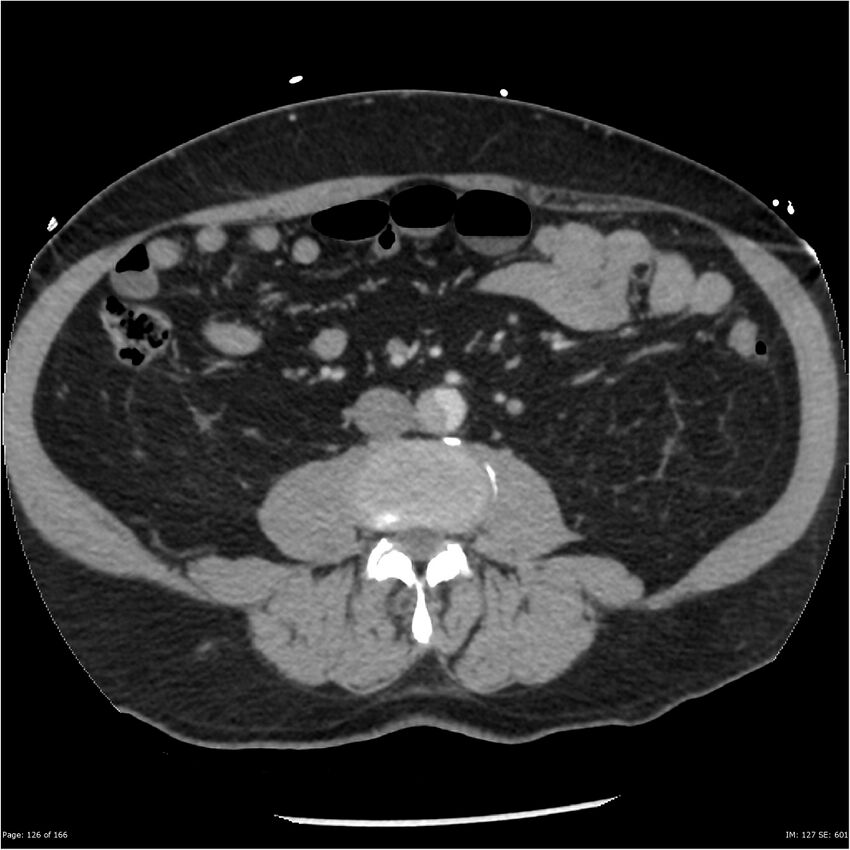 Aortic dissection- Stanford A (Radiopaedia 37759-39664 A 117).jpg