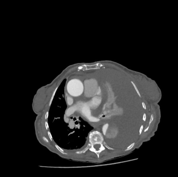 File:Aortic dissection (Radiopaedia 68763-78691 A 27).jpeg