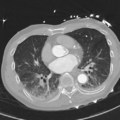 Aortic dissection - DeBakey type II (Radiopaedia 64302-73082 Axial lung window 37).png