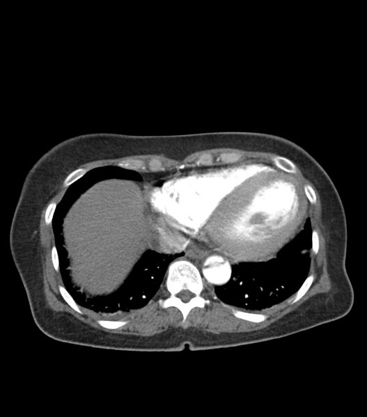 File:Aortic dissection with renal ischemia (Radiopaedia 76573-88338 A 51).jpg