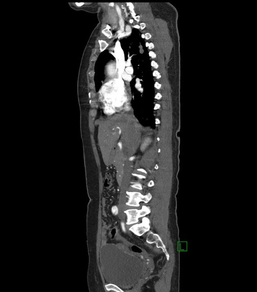 File:Aortic dissection with renal ischemia (Radiopaedia 76573-88338 D 10).jpg