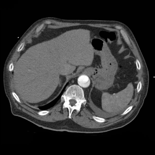File:Aortic dissection with rupture into pericardium (Radiopaedia 12384-12647 A 49).jpg