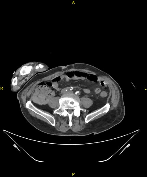 File:Aortoenteric fistula (Radiopaedia 84308-99603 Axial non-contrast 243).jpg