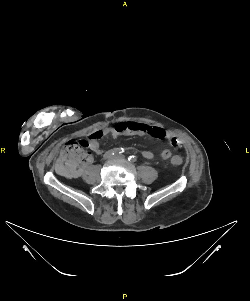 Aortoenteric fistula (Radiopaedia 84308-99603 Axial non-contrast 243).jpg