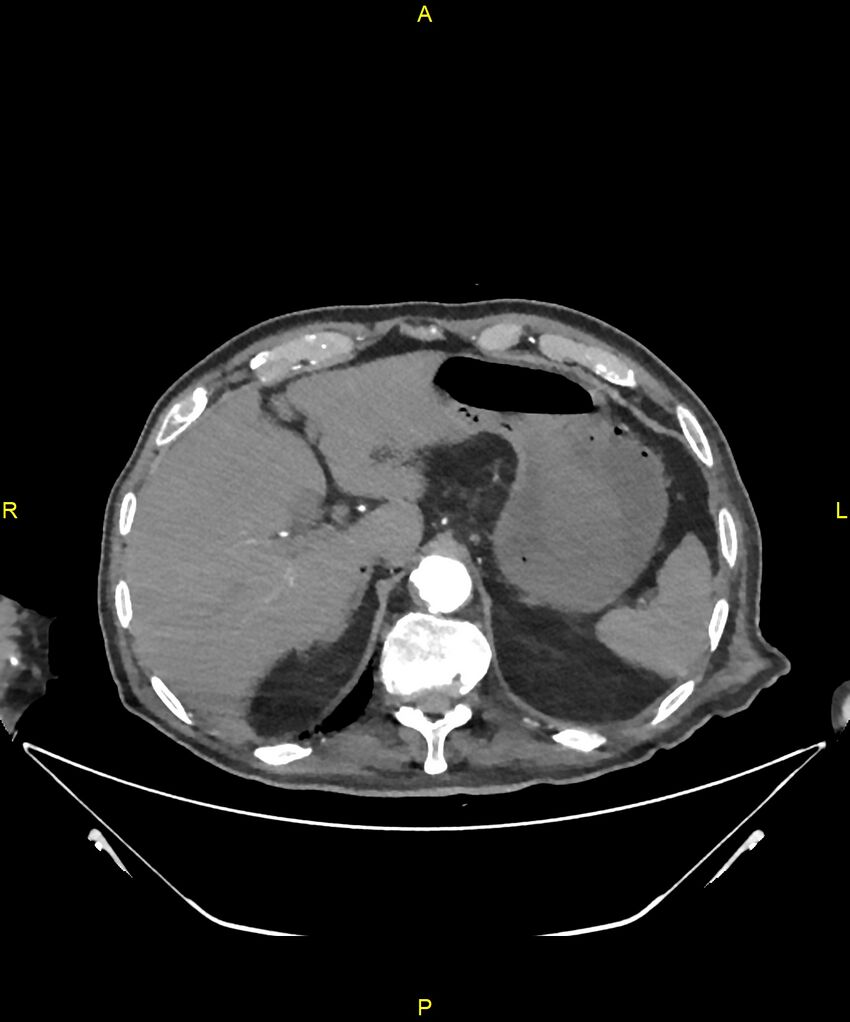 Aortoenteric fistula (Radiopaedia 84308-99603 B 58).jpg