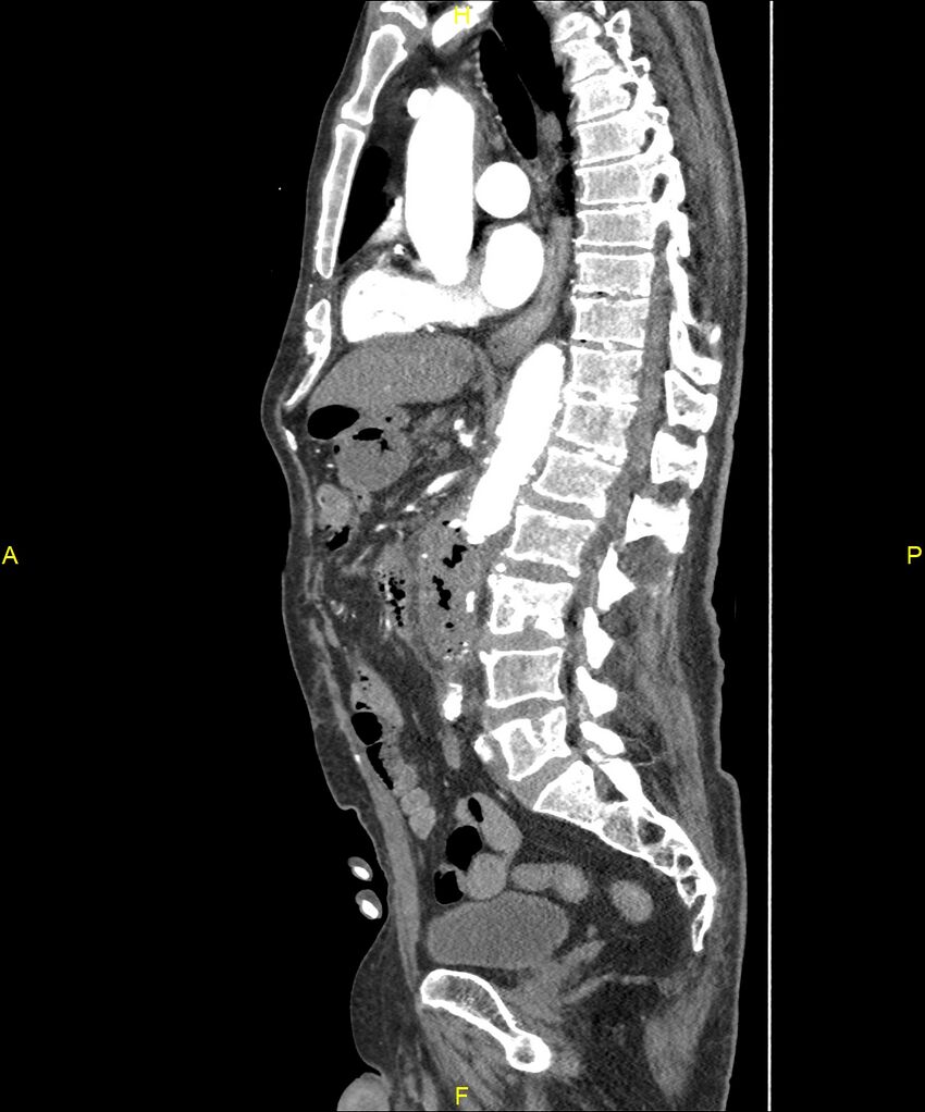 Aortoenteric fistula (Radiopaedia 84308-99603 C 179).jpg