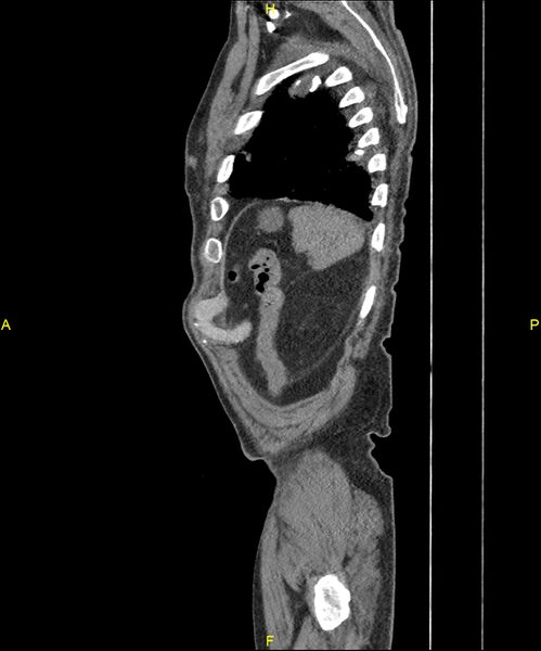 File:Aortoenteric fistula (Radiopaedia 84308-99603 C 303).jpg