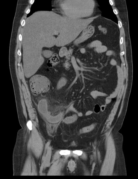 File:Appendicitis and giant appendicolith (Radiopaedia 80251-93588 Coronal non-contrast 16).jpg