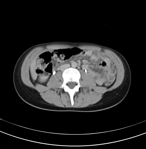 File:Appendicitis and incidental bicornuate uterus (Radiopaedia 22833-22853 Axial C+ delayed 17).jpg