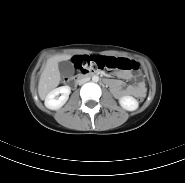 File:Appendicitis and incidental bicornuate uterus (Radiopaedia 22833-22853 B 19).jpg