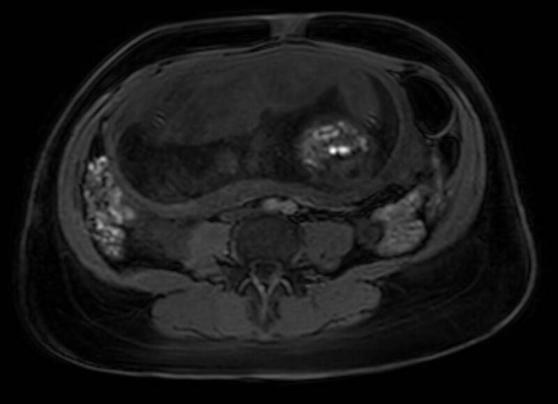 File:Appendicitis in gravida (MRI) (Radiopaedia 89433-106395 Axial DIXON 82).jpg