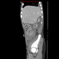 Appendicitis with phlegmon (Radiopaedia 9358-10046 F 8).jpg