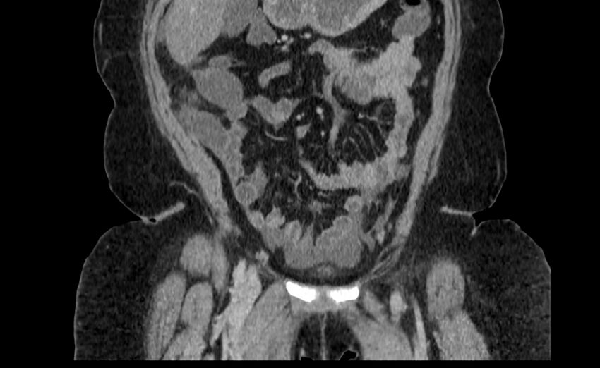 Appendix mucocele (Radiopaedia 41222-44033 B 16).jpg