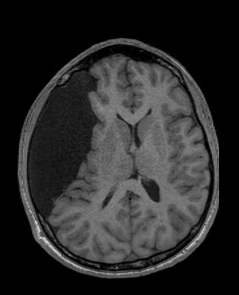 File:Arachnoid cyst- extremely large (Radiopaedia 68741-78451 Axial T1 44).jpg