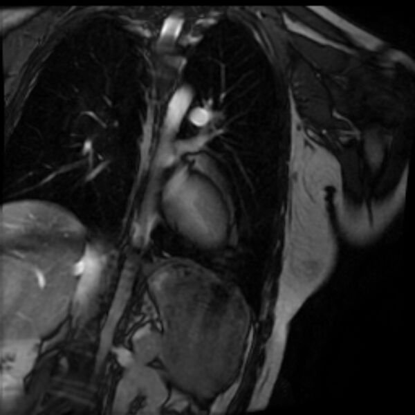 File:Arrhythmogenic right ventricular cardiomyopathy (Radiopaedia 87505-103850 2ch (LV) Cine SSFP 64).jpg
