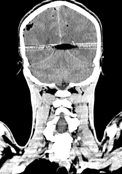 File:Arrow injury to the brain (Radiopaedia 72101-82607 Coronal non-contrast 53).jpg