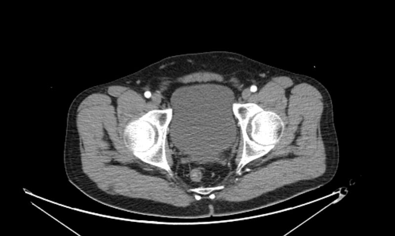 File:Arterial occlusive mesenteric ischemia (Radiopaedia 84641-100060 A 122).jpg