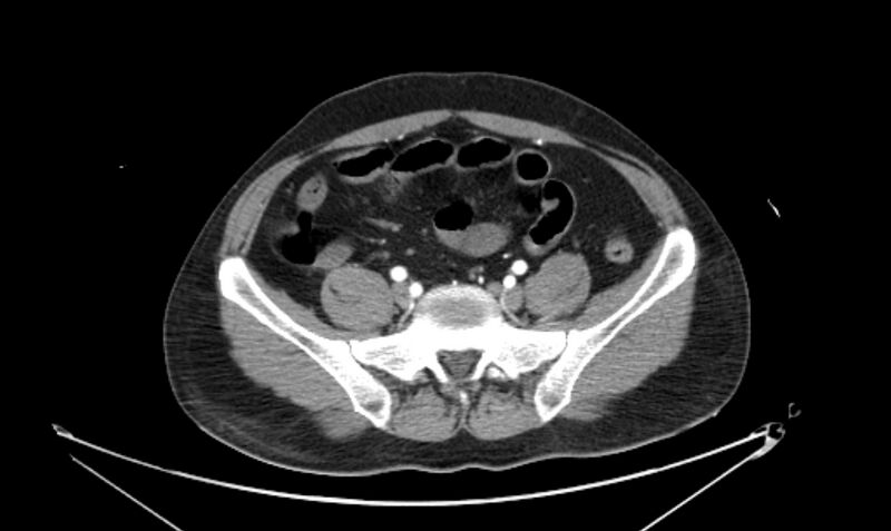 File:Arterial occlusive mesenteric ischemia (Radiopaedia 84641-100060 A 96).jpg