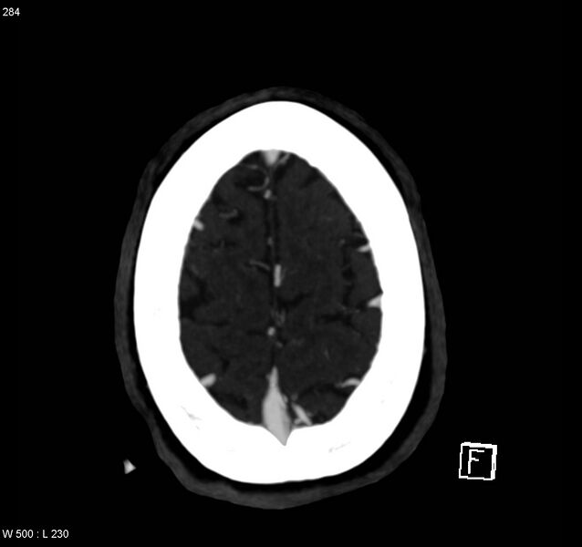 File:Arteriovenous malformation - cerebral (Radiopaedia 8172-14682 A 15).jpg