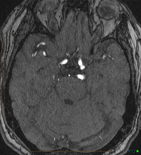 File:Artifactual basilar artery stenosis due to metallic stent (Radiopaedia 31206-31922 Axial MRA 14).jpg