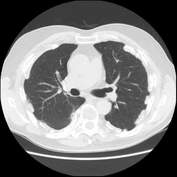 File:Asbestos-related pleural plaques (Radiopaedia 39069-41255 Axial lung window 33).jpg