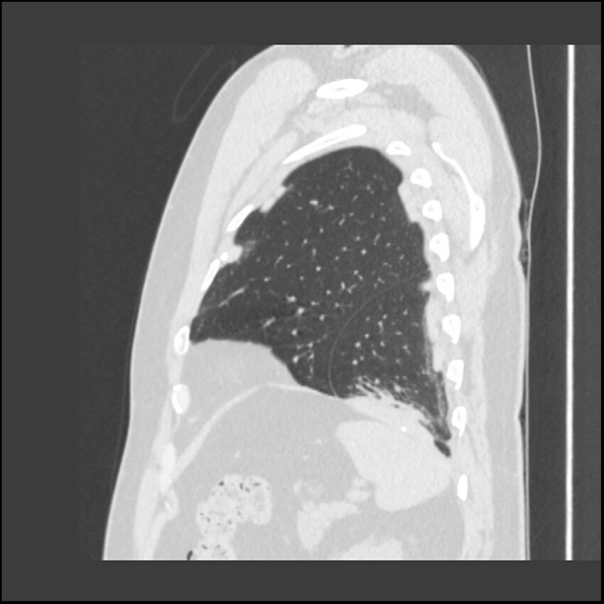 Asbestosis (Radiopaedia 45002-48961 Sagittal lung window 24).jpg