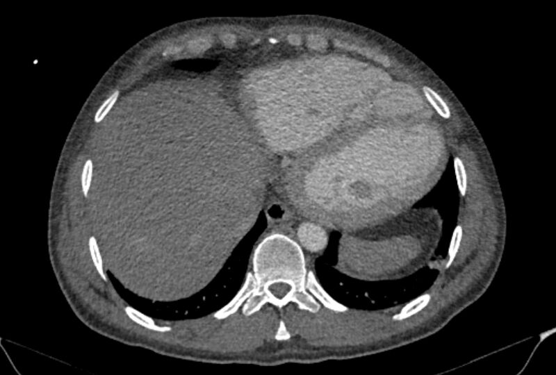 File:Ascending aortic aneurysm (Radiopaedia 86279-102297 C 54).jpg