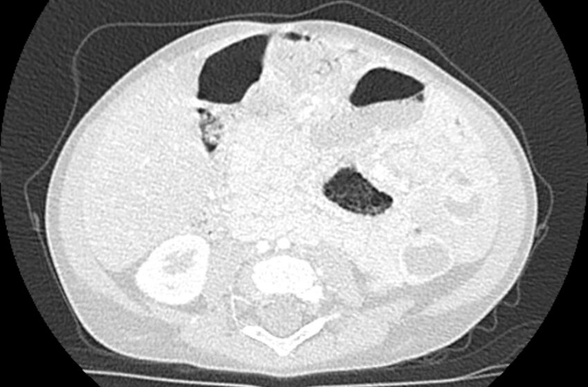 Asplenia syndrome (Radiopaedia 73083-83792 Axial lung window 106).jpg