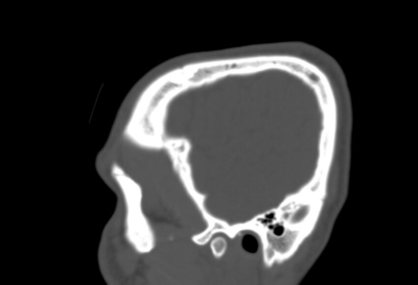 Asymptomatic occipital spur (Radiopaedia 87753-104201 Sagittal bone window 26).jpg
