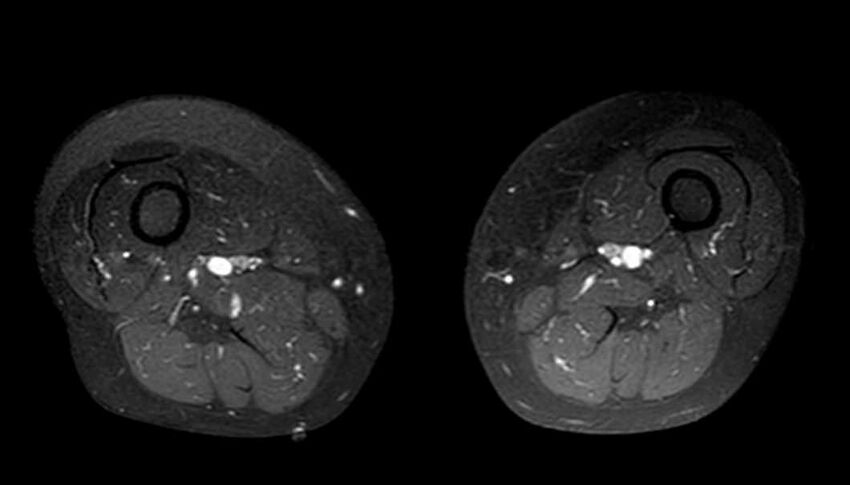 Atypical lipomatous tumor - thigh (Radiopaedia 68975-78734 Axial T1 C+ fat sat 41).jpg