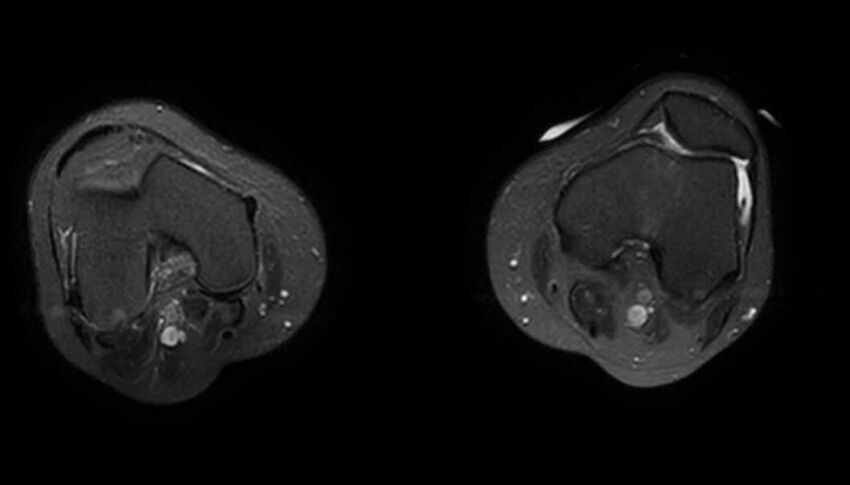 Atypical lipomatous tumor - thigh (Radiopaedia 68975-78734 Axial T2 fat sat 10).jpg