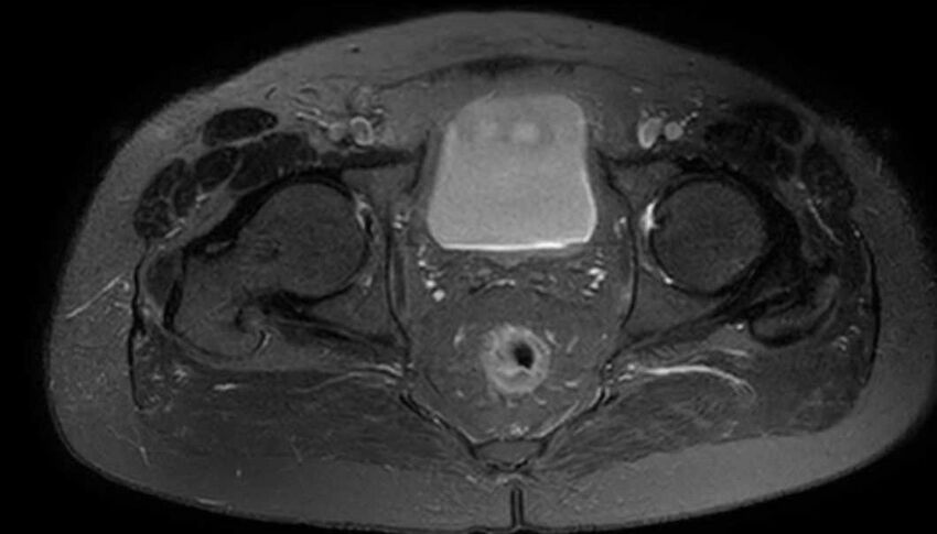 Atypical lipomatous tumor - thigh (Radiopaedia 68975-78734 Axial T2 fat sat 93).jpg