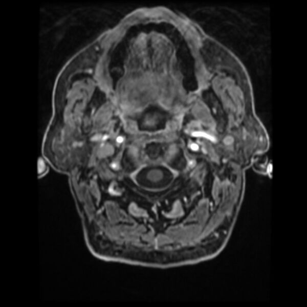 File:Atypical meningioma (Radiopaedia 45535-49629 Axial T1 C+ 10).jpg