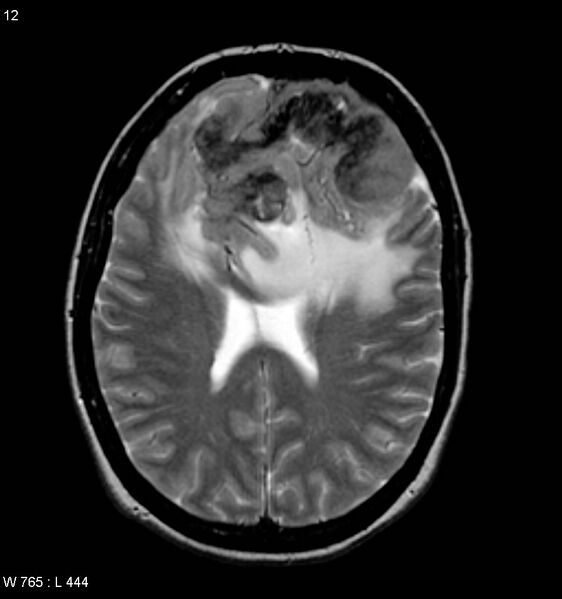 File:Atypical meningioma (WHO grade II) (Radiopaedia 7762-8586 Axial T2 4).jpg